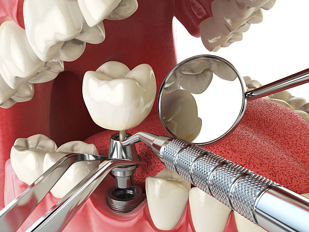 Best Emergency Denture Repair in Lawai, HI